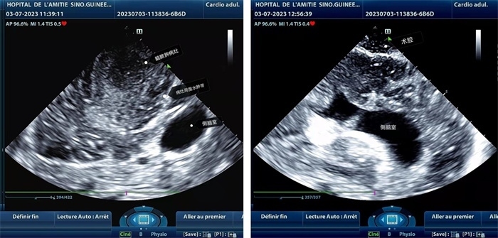 左圖顯示術(shù)中超聲見囊實(shí)性病變，大小約為4x4x3cm，病灶周圍腦組織水腫明顯；右圖為病灶切除后，術(shù)中超聲示術(shù)腔無病變殘留