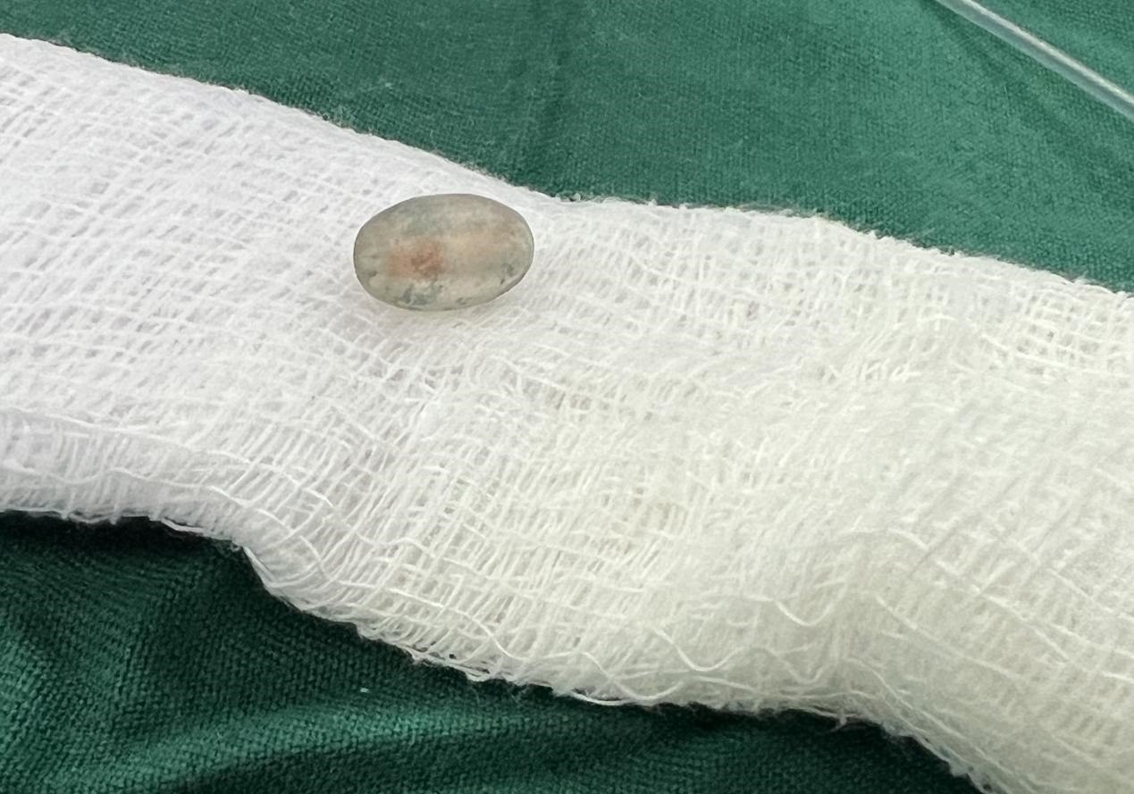 被取出的異物。中國(guó)援桑醫(yī)療隊(duì)供圖