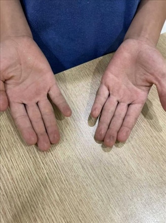 9歲小學(xué)生長期拍煙卡，手部粗糙長繭。受訪者供圖