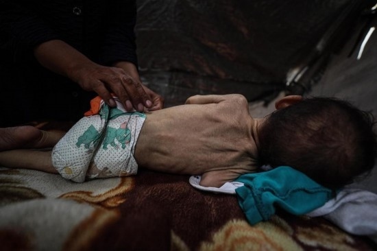 這是5月28日在加沙城西部一處臨時(shí)安置點(diǎn)拍攝的一名營(yíng)養(yǎng)不良的嬰兒。新華社發(fā)（馬哈茂德·扎基攝）